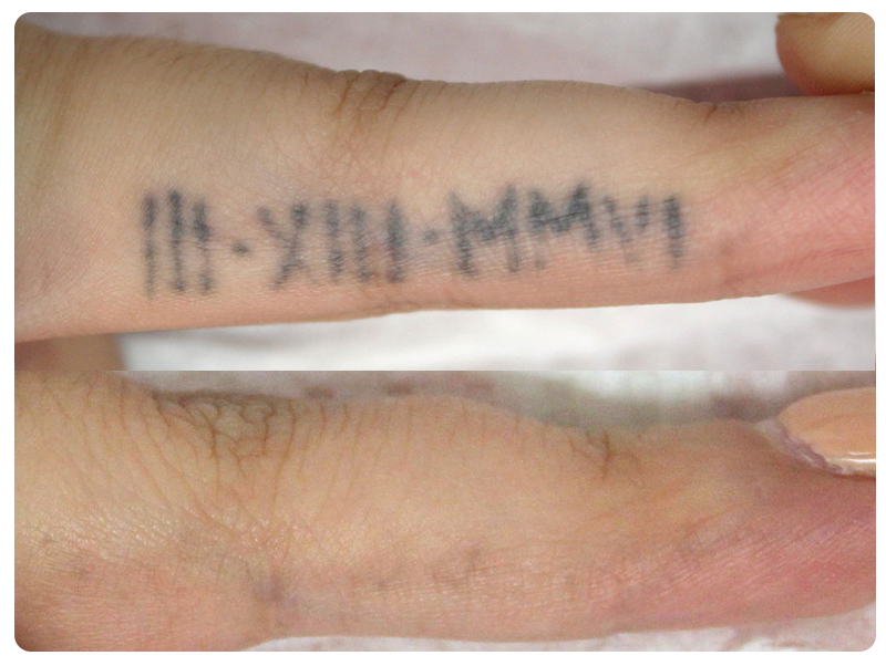 Noticeable fading and cleaner lines after 3 treatments.
