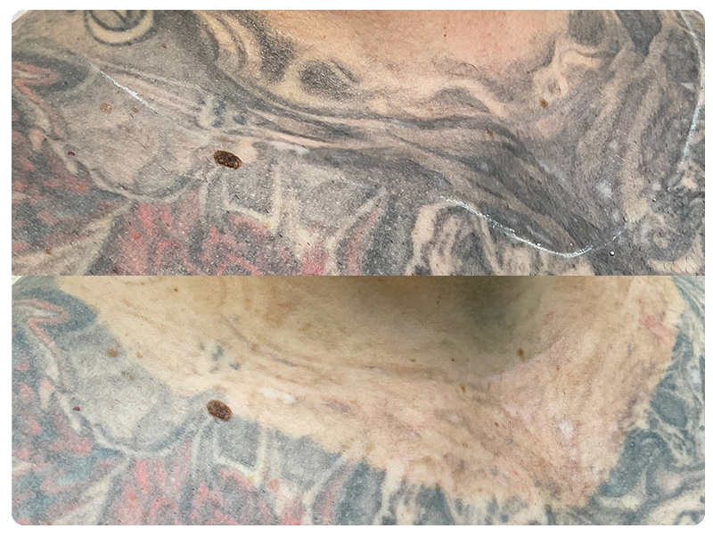 Targeted fading to prep for a cover up