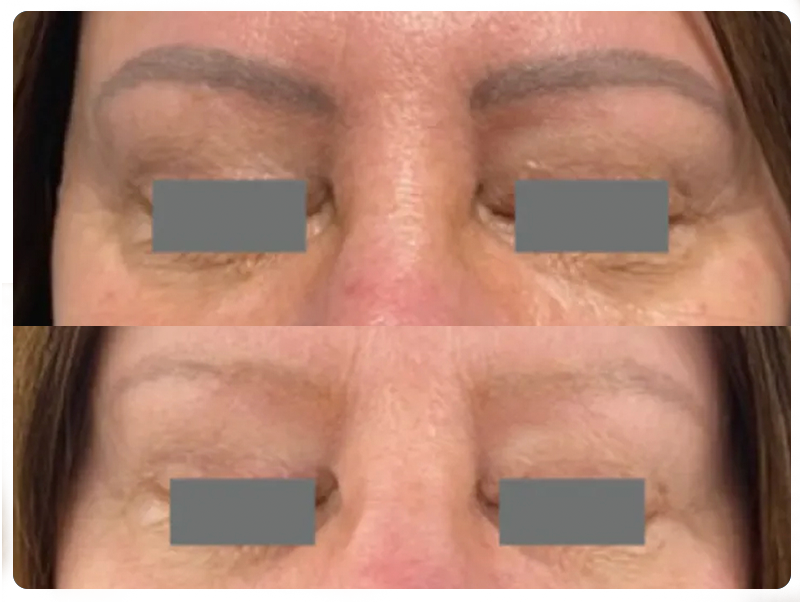 Lightening cosmetic pigment safely and gradually.